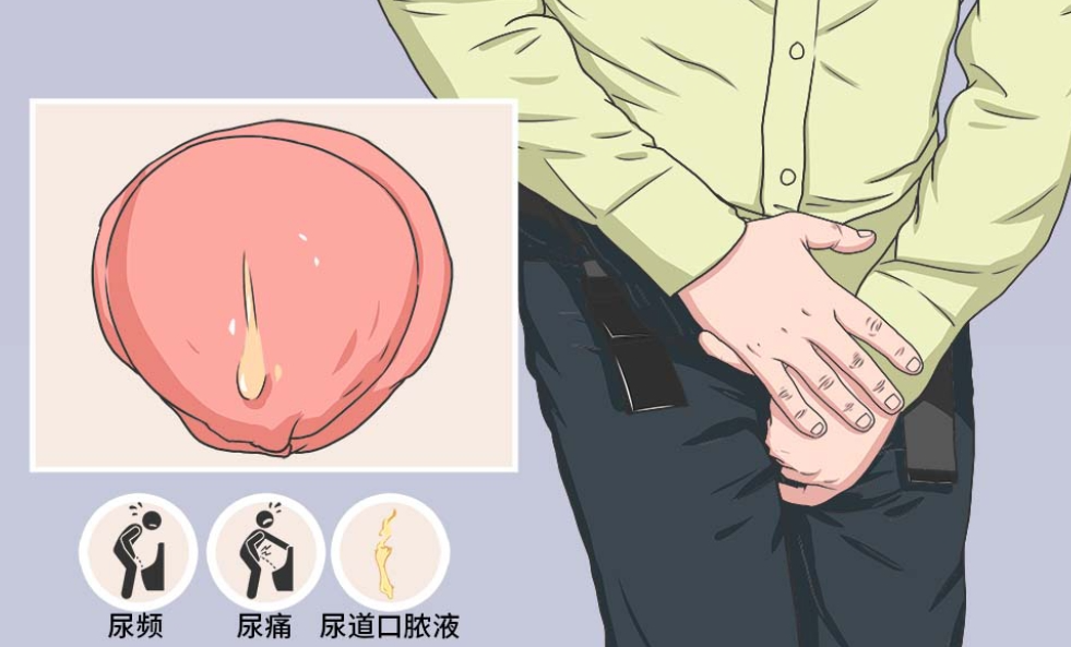 健康直击：南通排名好的男科医院“成功上榜”男性尿道口流脓什么病？