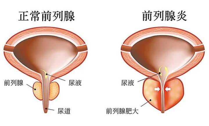 健康一览：南通男性泌尿科医院排名“公开发布”南通治前列腺炎哪家医院是专业的呢？