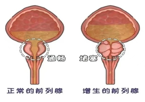 本周热议：南通前列腺炎专科医院“排名公布”南通前列腺专科医院哪家好？