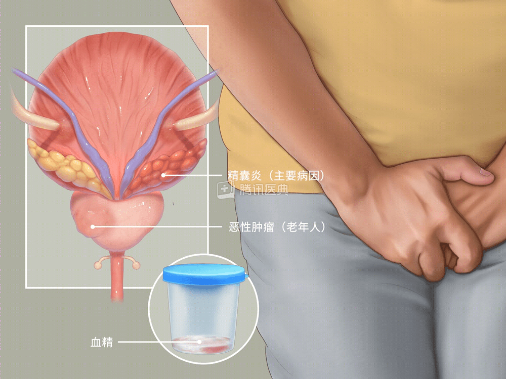 口口相传：南通男科医院排行榜“排名揭晓”射精带血是什么原因造成的呢？
